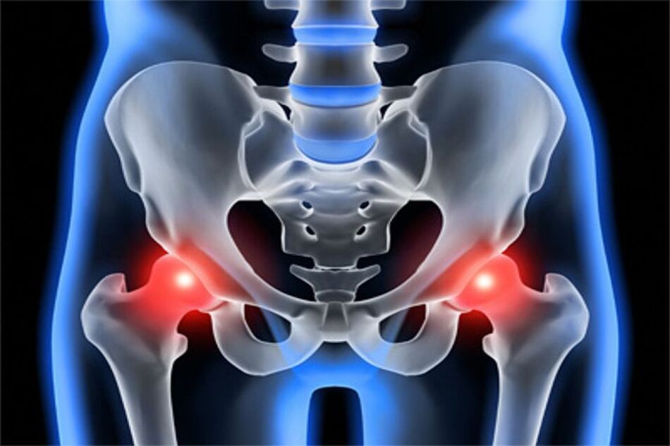 Deforming arthrosis of the hip joints (coxarthrosis)