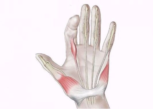 Inflammation of the tendon causing pain in the joints of the fingers