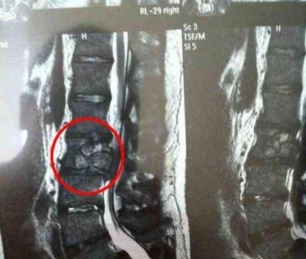 spinal tumor causing back pain