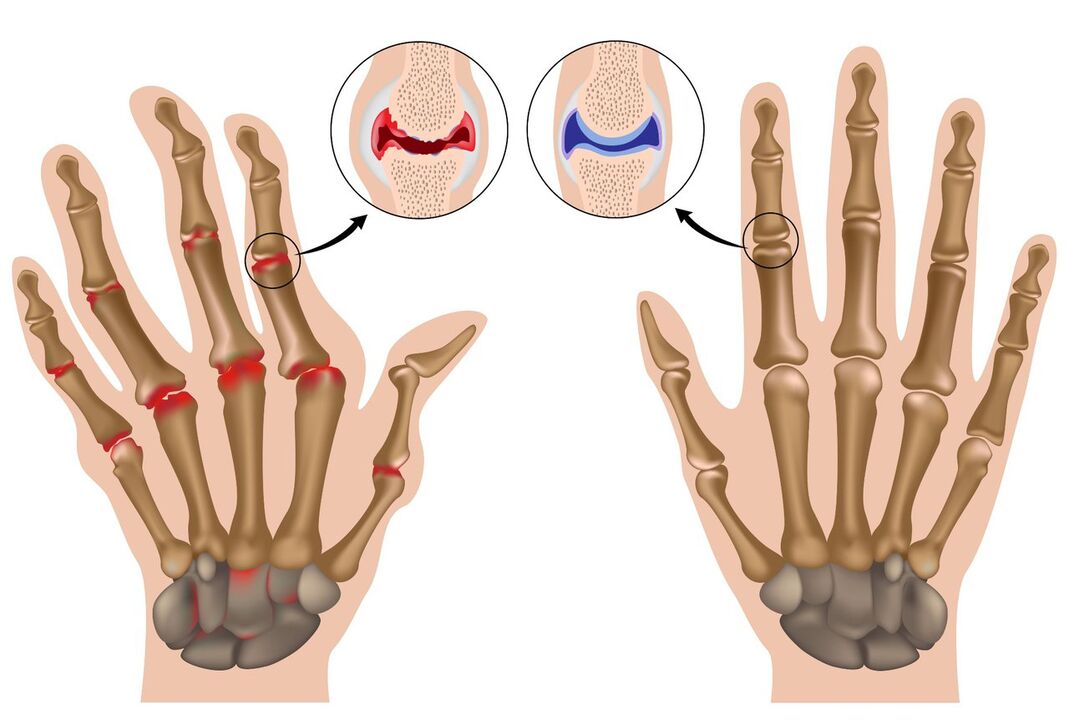 healthy and affected hand joints with polyarthritis