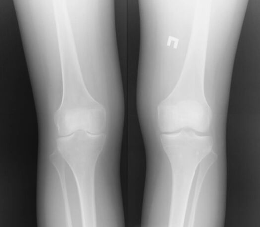 Knee radiograph