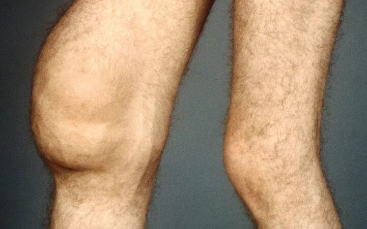 Post -tractic arthrosis of knee joint