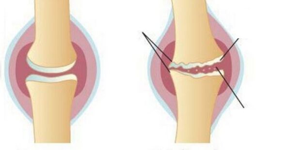 Cartilage washing