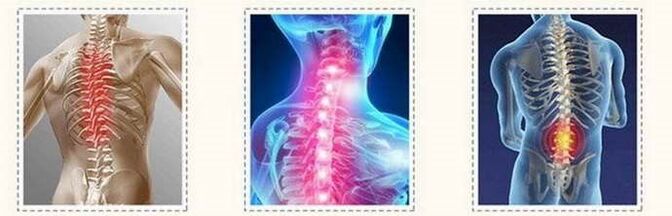 Osteochondrosis spinal lesion