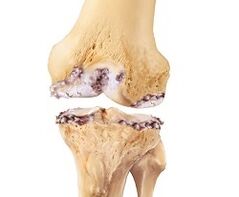 Damage to the knee joint due to arthrosis