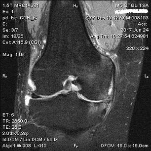 Osteoarthritis of the knee joint on MRI