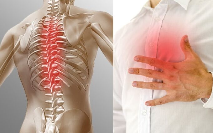 Thoracic osteochondrosis is manifested by pain and a feeling of tightness in the chest.